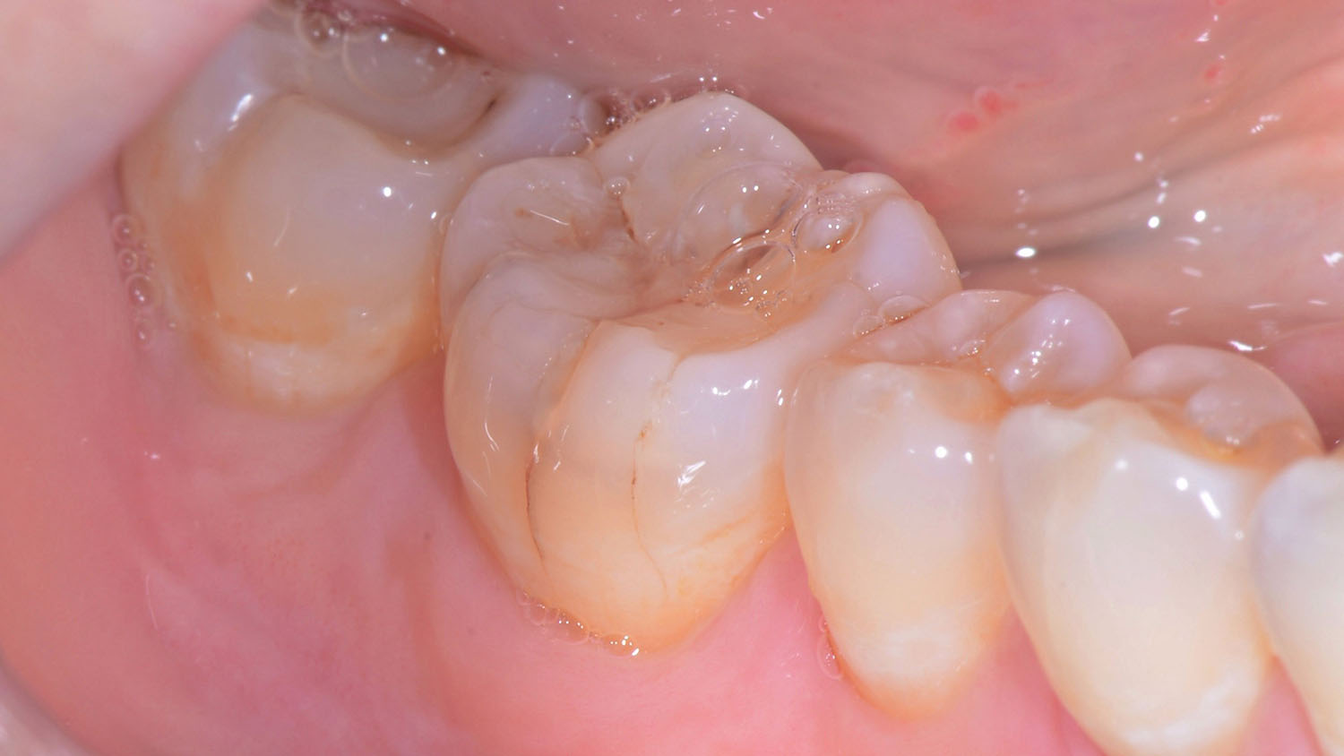 Exposed Nerves? How an Emergency Dentist Can Help